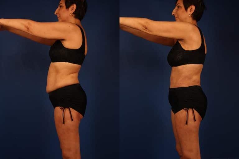 Melissa - Before and After Side