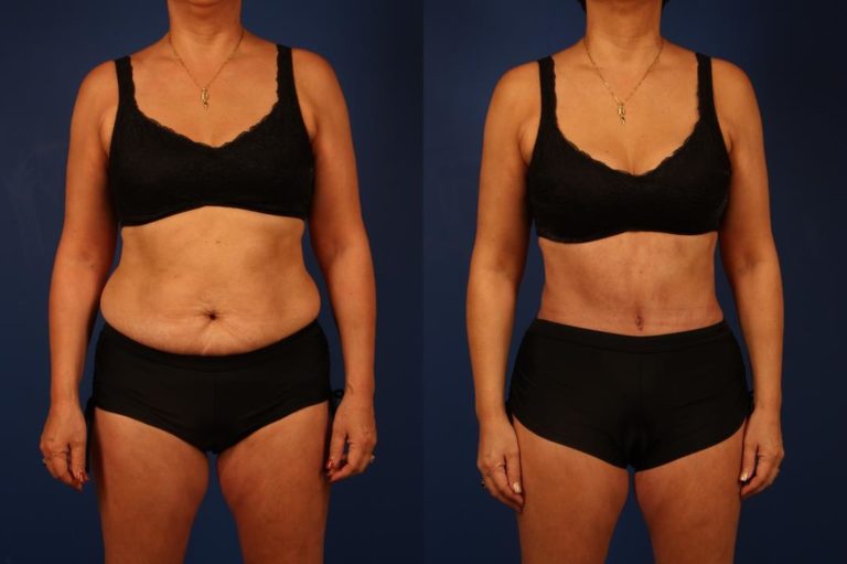 Melissa - Before and After Front