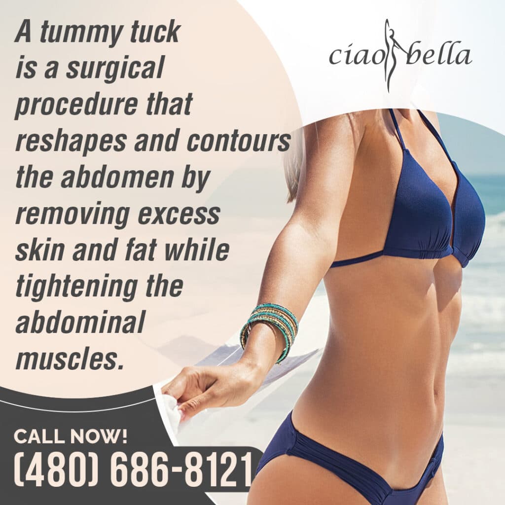tummy tuck for muscle repair